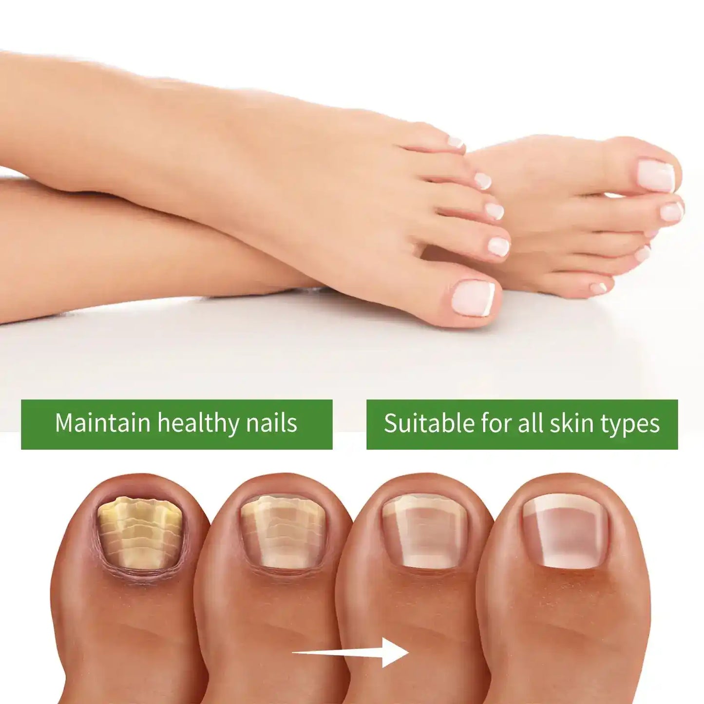 FungiBalm® Instantly fights resistant fungal nails