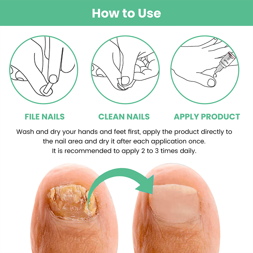 ZeroFungi® - Get rid of nail and toenail fungus naturally!