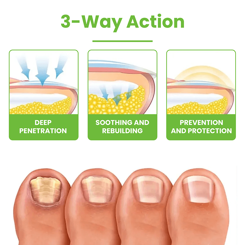 FungiSolve® | Naturally kills toenail fungus and bacteria!