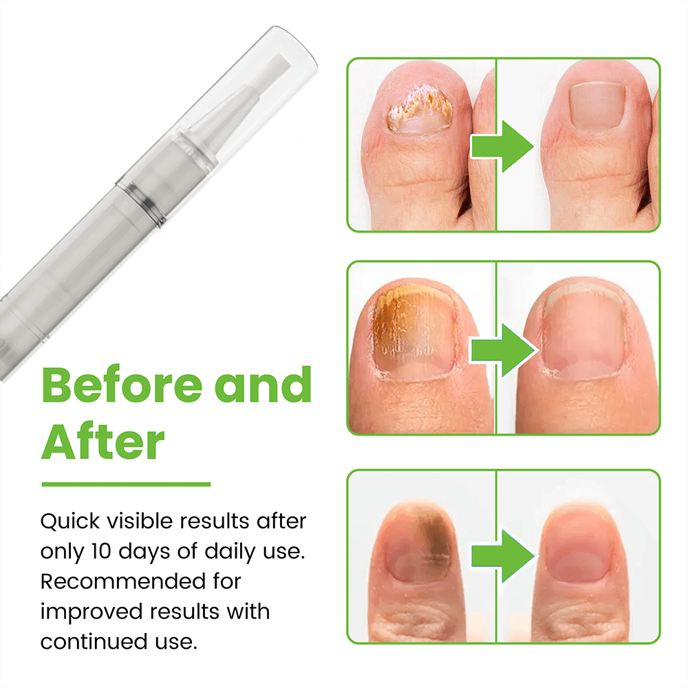 FungiSolve® | Naturally kills toenail fungus and bacteria!