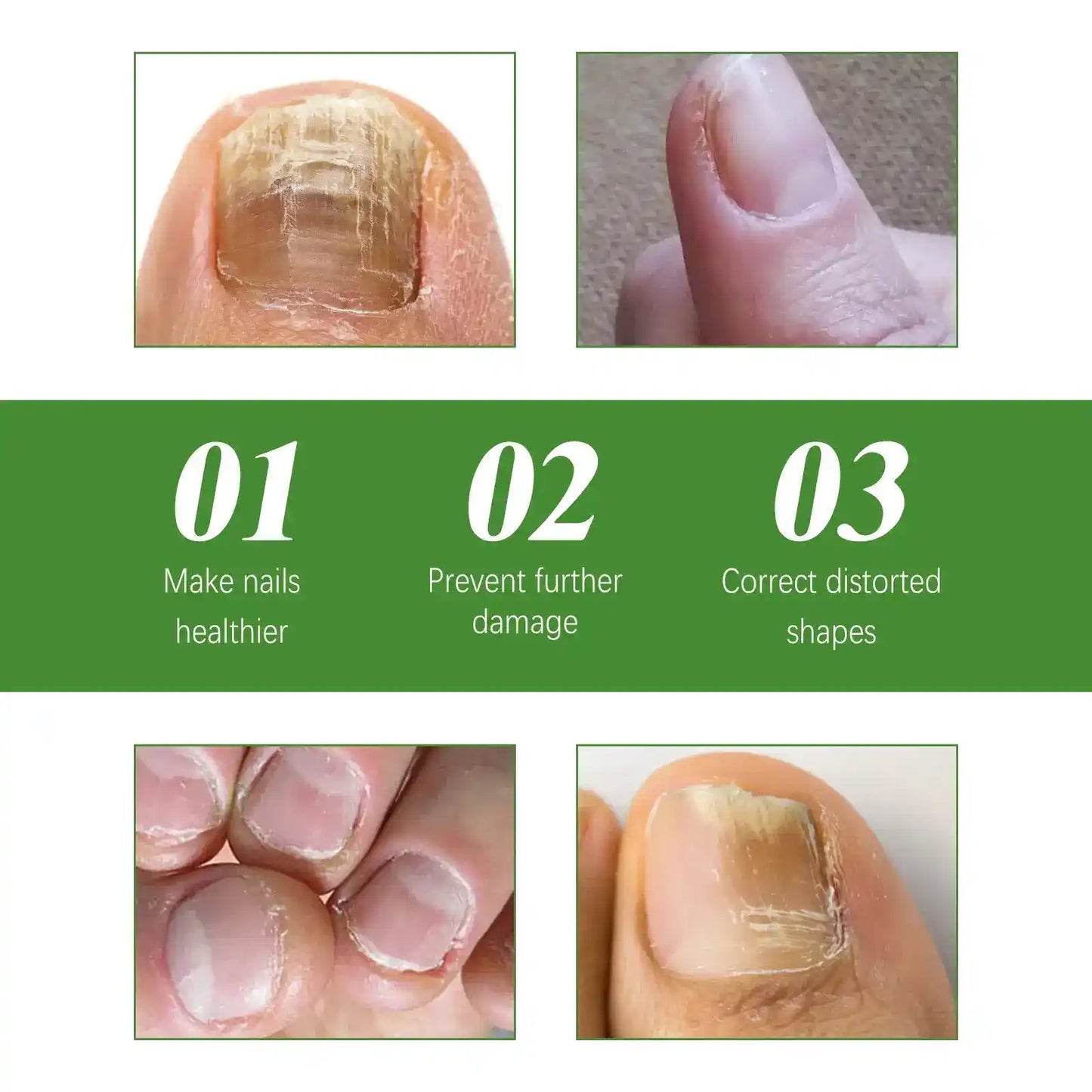 FungiBalm® Instantly fights resistant fungal nails