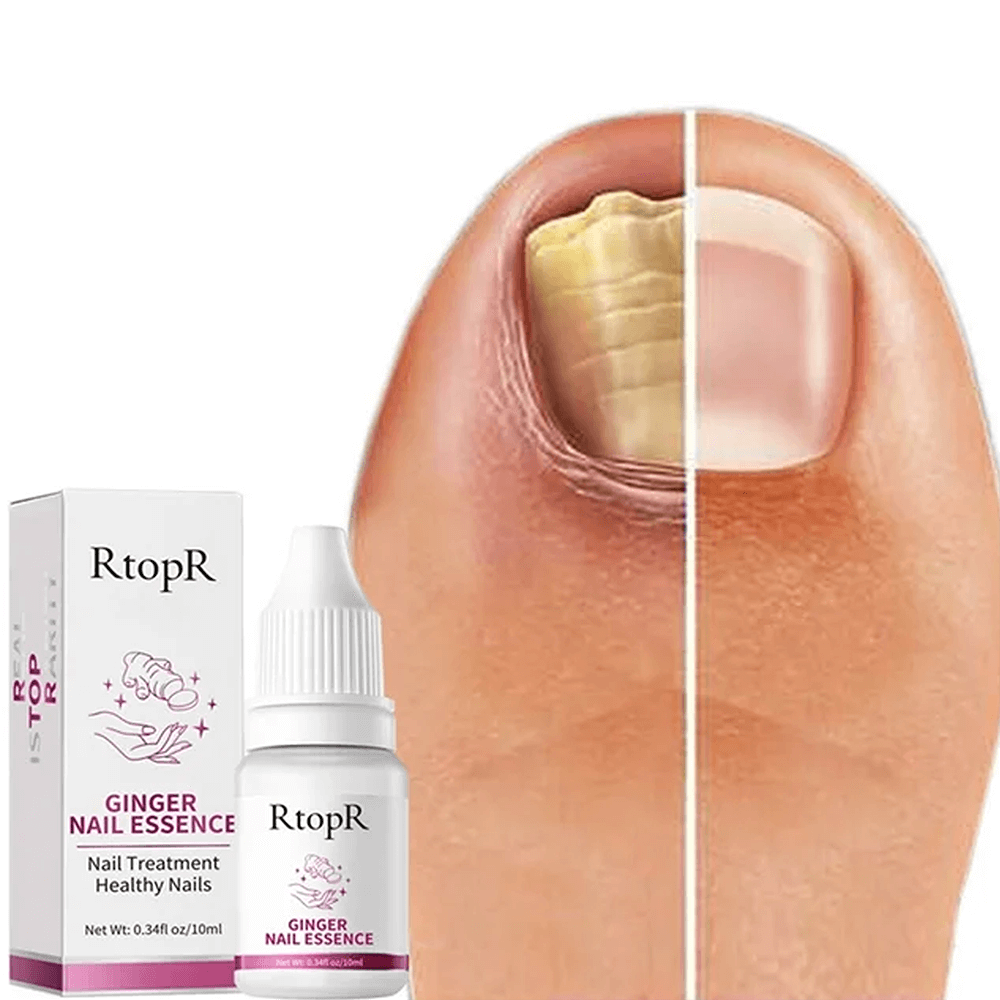 ZeroFungi® - Get rid of nail and toenail fungus naturally!